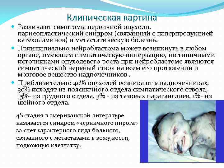 Клиническая картина Различают симптомы первичной опухоли, парнеопластический синдром (связанный с гиперпродукцией катехоламинов) и метастатическую