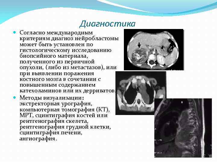 Диагностика Согласно международным критериям диагноз нейробластомы может быть установлен по гистологическому исследованию биопсийного материала,