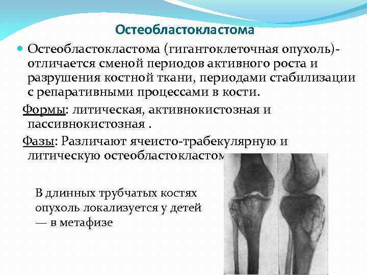Остеобластокластома (гигантоклеточная опухоль) отличается сменой периодов активного роста и разрушения костной ткани, периодами стабилизации