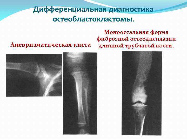 Дифференциальная диагностика остеобластокластомы. Аневризматическая киста Монооссальная форма фиброзной остеодисплазии длинной трубчатой кости. 