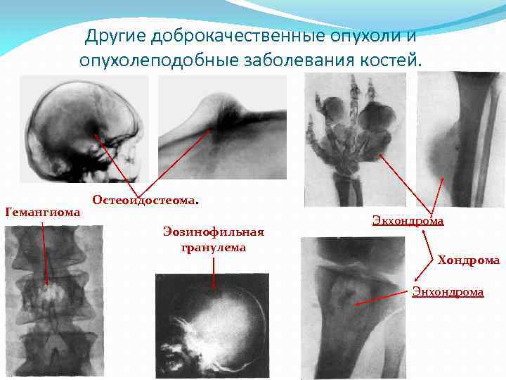 Другие доброкачественные опухоли и опухолеподобные заболевания костей. Гемангиома Остеоидостеома. Эозинофильная гранулема Экхондрома Хондрома Энхондрома