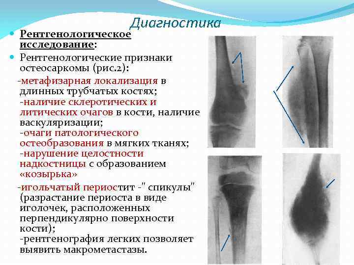 Диагностика Рентгенологическое исследование: Рентгенологические признаки остеосаркомы (рис. 2): метафизарная локализация в длинных трубчатых костях;