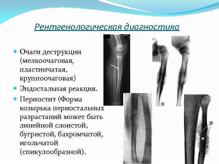 Рентгенологическая диагностика Очаги деструкции (мелкоочаговая, пластинчатая, крупноочаговая) Эндостальная реакция. Периостит (Форма козырька периостальных разрастаний