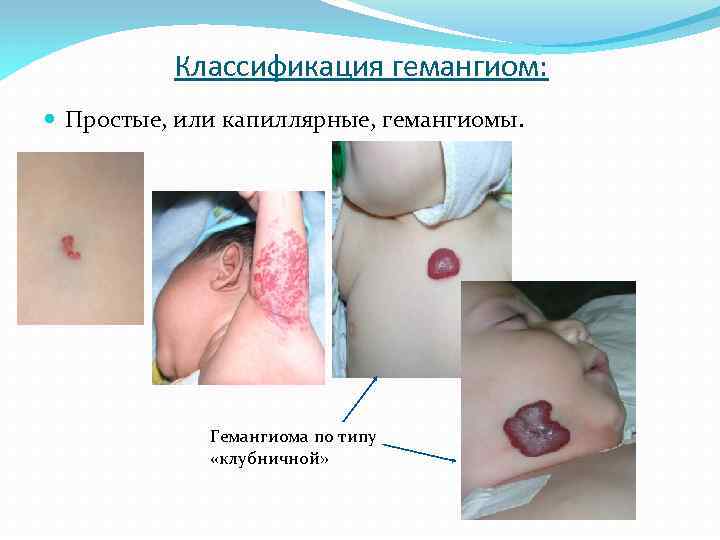 Классификация гемангиом: Простые, или капиллярные, гемангиомы. Гемангиома по типу «клубничной» 