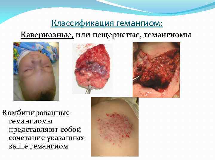 Классификация гемангиом: Кавернозные, или пещеристые, гемангиомы Комбинированные гемангиомы представляют собой сочетание указанных выше гемангиом