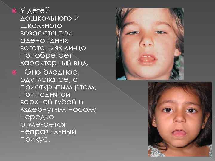 Аденоидные вегетации 3. Аденоидный Тип лица у детей. Аденоидный Тип лица характерен для детей. Аденоидитное лицо у ребенка.