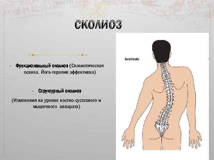 сколиоз - Функциональный сколиоз (Сколиотическая осанка. Йога-терапия эффективна) - Структурный сколиоз (Изменения на уровне