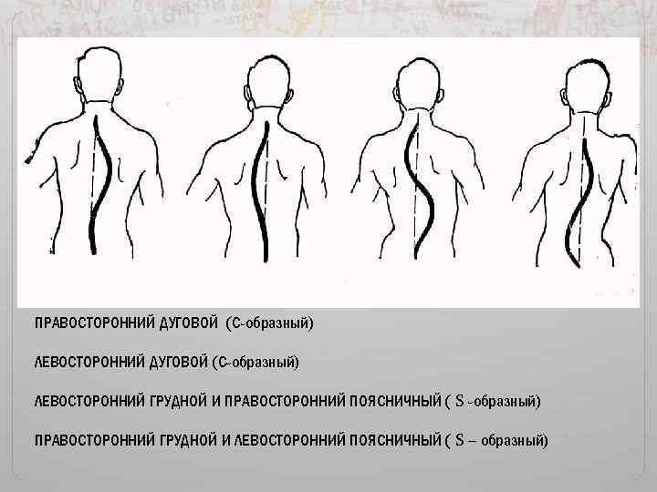 ПРАВОСТОРОННИЙ ДУГОВОЙ (С-образный) ЛЕВОСТОРОННИЙ ГРУДНОЙ И ПРАВОСТОРОННИЙ ПОЯСНИЧНЫЙ ( S -образный) ПРАВОСТОРОННИЙ ГРУДНОЙ И