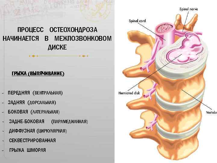 ПРОЦЕСС ОСТЕОХОНДРОЗА НАЧИНАЕТСЯ В МЕЖПОЗВОНКОВОМ ДИСКЕ ГРЫЖА (ВЫПЯЧИВАНИЕ) - ПЕРЕДНЯЯ (ВЕНТРАЛЬНАЯ) - ЗАДНЯЯ (ДОРСАЛЬНАЯ)