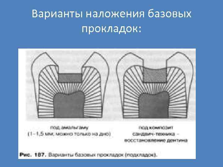 Варианты наложения базовых прокладок: 