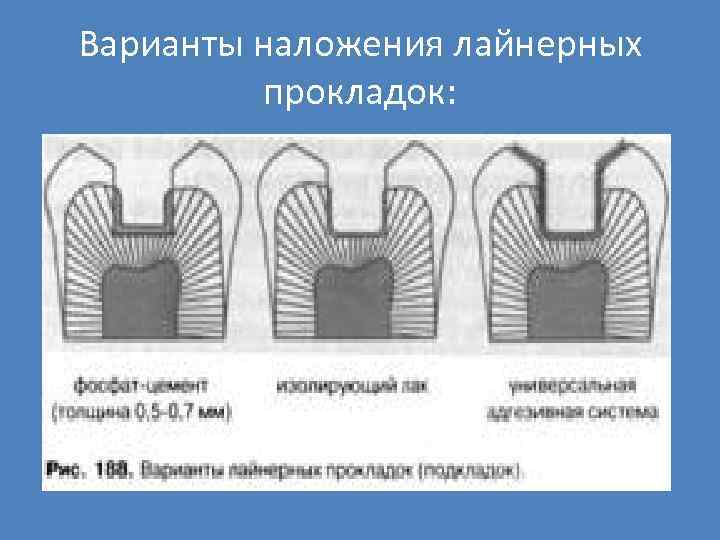 Варианты наложения лайнерных прокладок: 