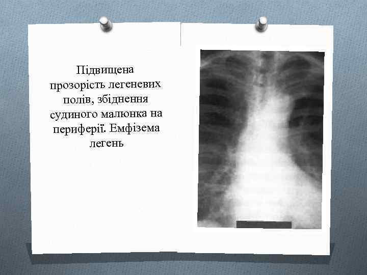 Підвищена прозорість легеневих полів, збіднення судиного малюнка на периферії. Емфізема легень 