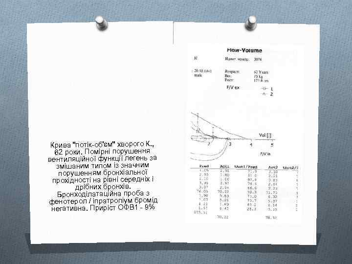 Крива "потік-об'єм" хворого К. , 62 роки. Помірні порушення вентиляційної функції легень за змішаним