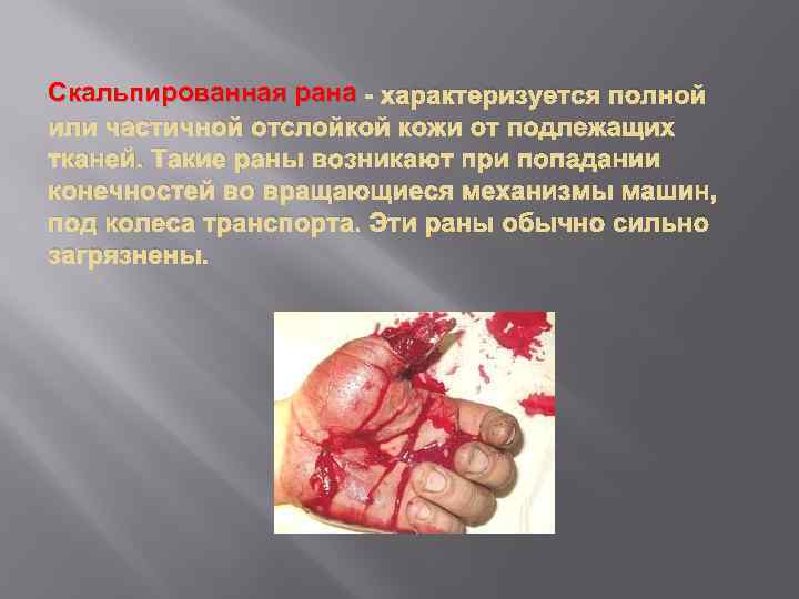 Скальпированная рана - характеризуется полной или частичной отслойкой кожи от подлежащих тканей. Такие раны