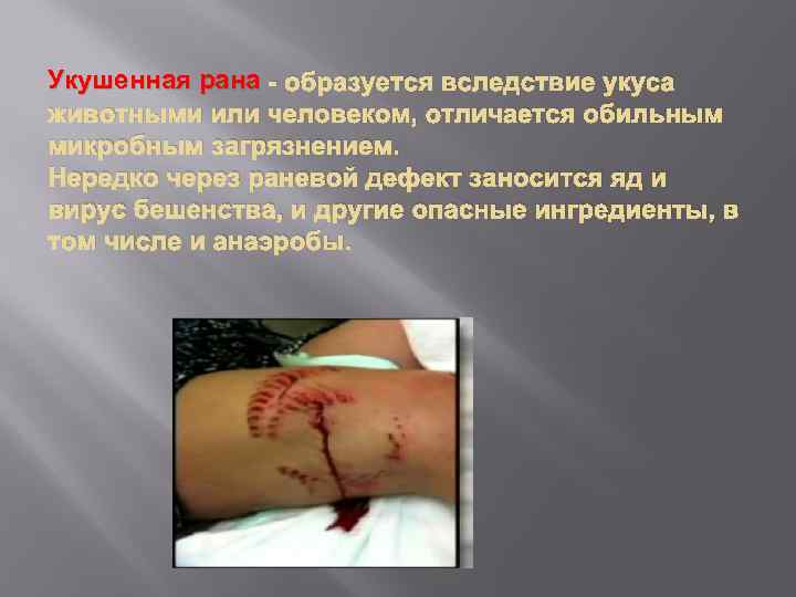 Укушенная рана - образуется вследствие укуса животными или человеком, отличается обильным микробным загрязнением. Нередко