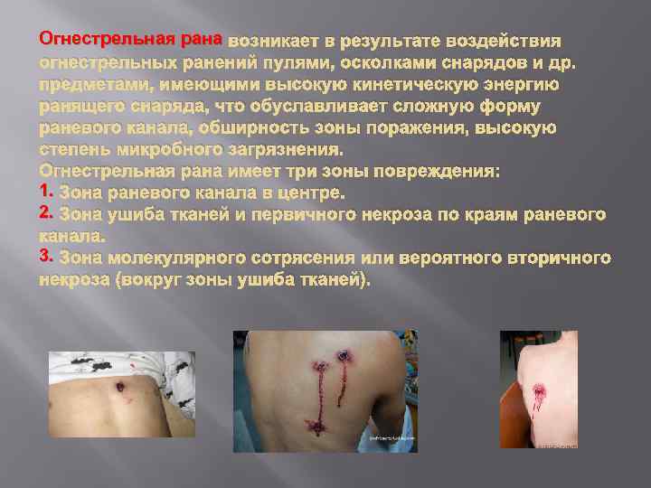Огнестрельная рана возникает в результате воздействия огнестрельных ранений пулями, осколками снарядов и др. предметами,