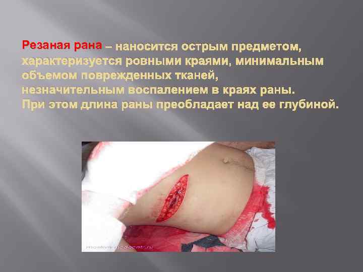 Резаная рана – наносится острым предметом, характеризуется ровными краями, минимальным объемом поврежденных тканей, незначительным