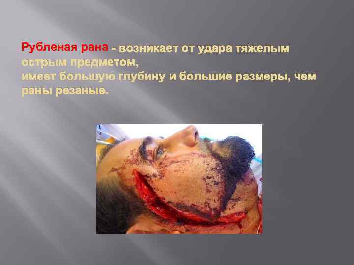 Рубленая рана - возникает от удара тяжелым острым предметом, имеет большую глубину и большие