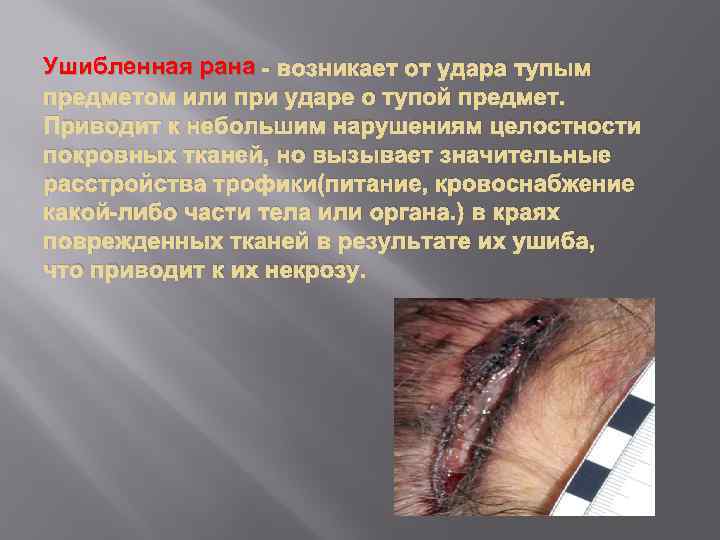 Ушибленная рана - возникает от удара тупым предметом или при ударе о тупой предмет.