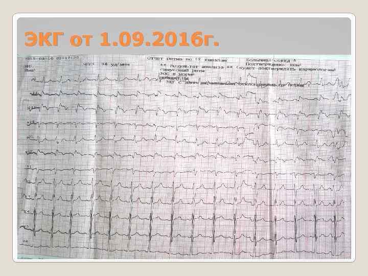 ЭКГ от 1. 09. 2016 г. 