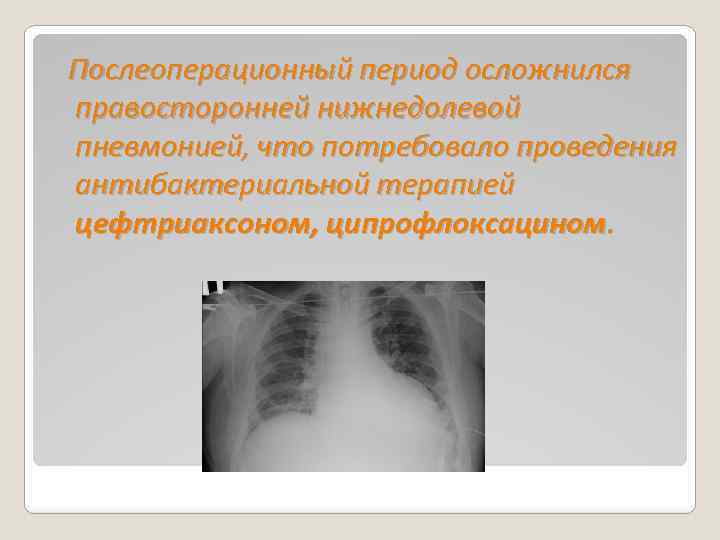  Послеоперационный период осложнился правосторонней нижнедолевой пневмонией, что потребовало проведения антибактериальной терапией цефтриаксоном, ципрофлоксацином.