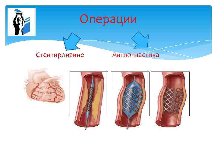 Операции Стентирование Ангиопластика 