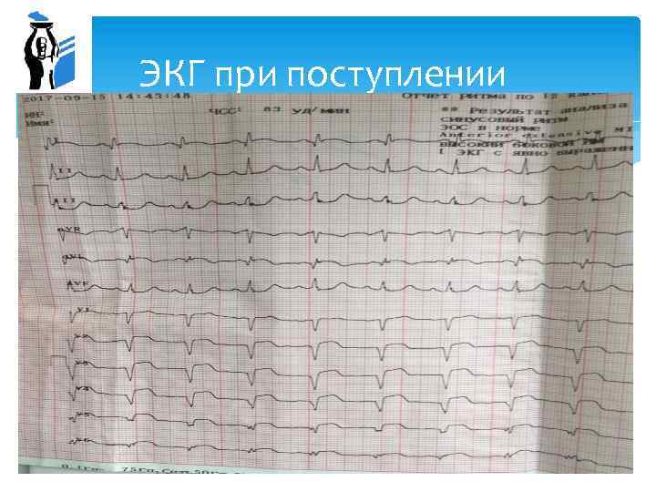 ЭКГ при поступлении 