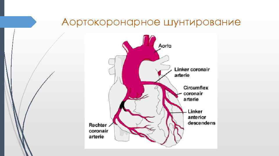 Аортокоронарное шунтирование схема операции