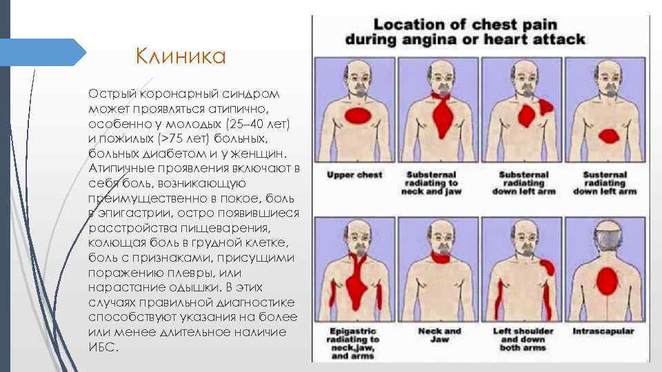 Боль при инфаркте. Острый коронарный синдром клиника. Окс болевой синдром. Характеристика боли при Окс. Атипичные формы Окс.