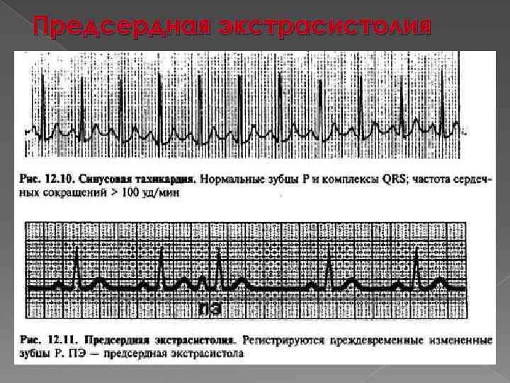 Предсердная экстрасистолия 