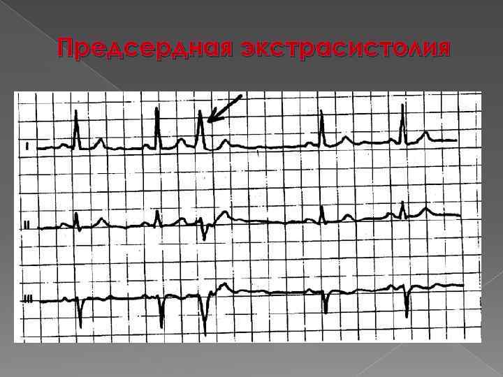 Предсердная экстрасистолия 