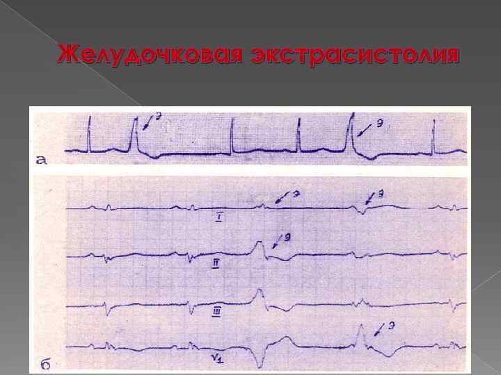 Желудочковая экстрасистолия 