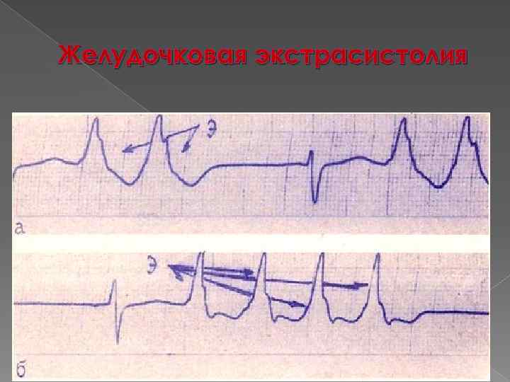 Желудочковая экстрасистолия 