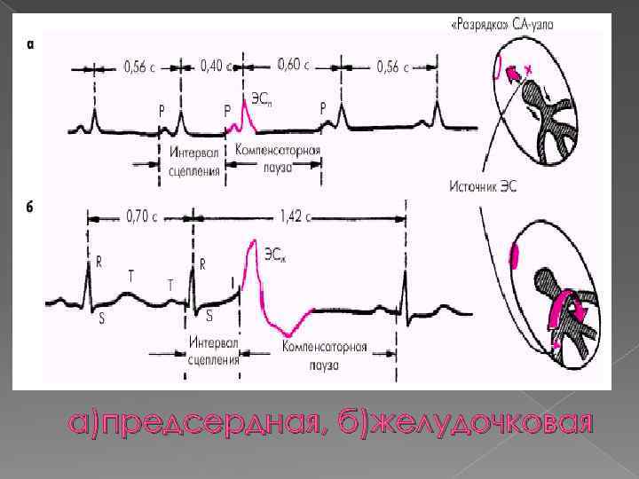 а)предсердная, б)желудочковая 