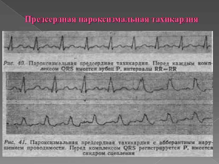 Предсердная пароксизмальная тахикардия 