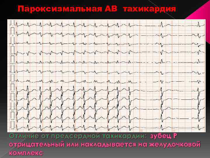 Пароксизмальная АВ тахикардия Отличие от предсердной тахикардии: зубец Р отрицательный или накладывается на желудочковой