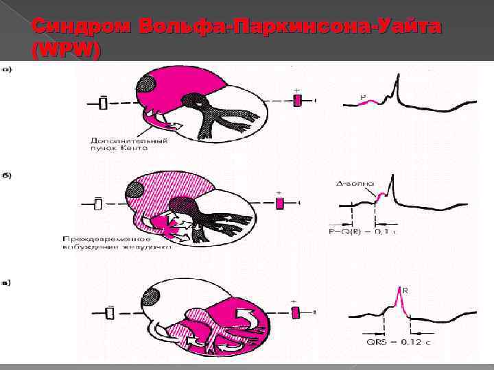 Синдром Вольфа-Паркинсона-Уайта (WPW) 