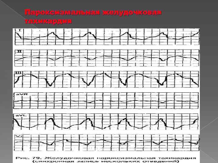 Пароксизмальная желудочковая тахикардия 