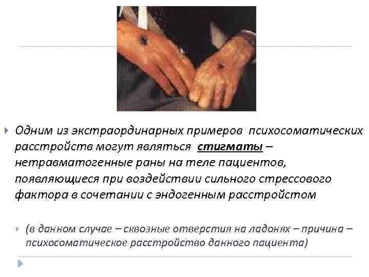  Одним из экстраординарных примеров психосоматических расстройств могут являться стигматы – нетравматогенные раны на