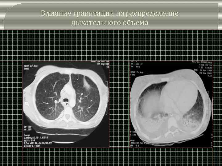 Влияние гравитации на распределение дыхательного объема 