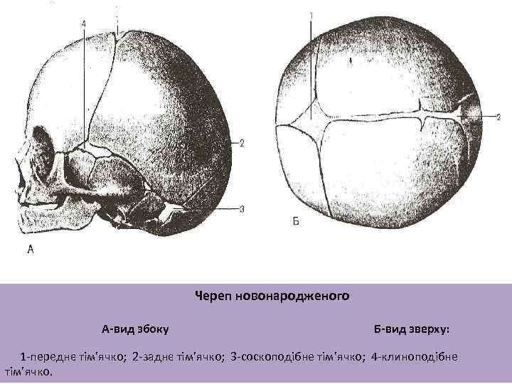 Череп новонародженого А-вид збоку Б-вид зверху: 1 -переднє тім’ячко; 2 -заднє тім’ячко; 3 -соскоподібне