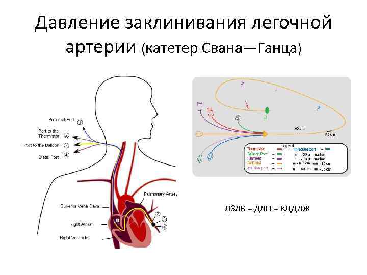 Давление заклинивания легочной артерии (катетер Свана—Ганца) ДЗЛК = ДЛП = КДДЛЖ 