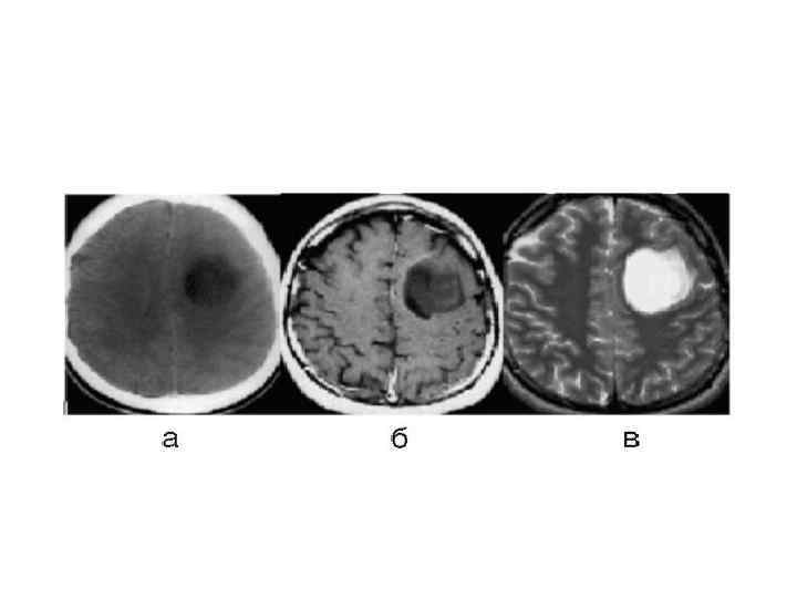 Злокачественные опухоли цнс. Метастатические опухоли ЦНС. Внутримозговые опухоли ЦНС. Глиальные опухоли центральной нервной системы.
