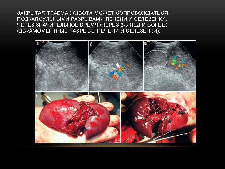 ЗАКРЫТАЯ ТРАВМА ЖИВОТА МОЖЕТ СОПРОВОЖДАТЬСЯ ПОДКАПСУЛЬНЫМИ РАЗРЫВАМИ ПЕЧЕНИ И СЕЛЕЗЕНКИ. ЧЕРЕЗ ЗНАЧИТЕЛЬНОЕ ВРЕМЯ (ЧЕРЕЗ