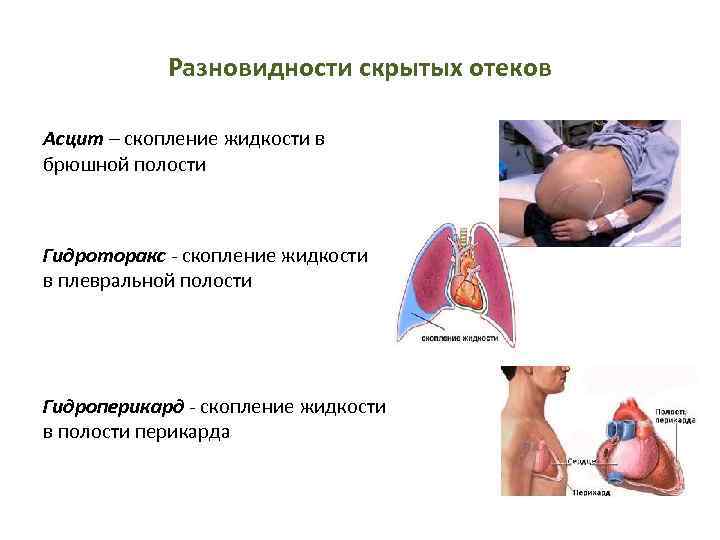 Асцит брюшной полости фото