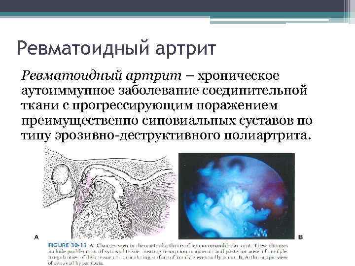 Ревматоидный артрит – хроническое аутоиммунное заболевание соединительной ткани с прогрессирующим поражением преимущественно синовиальных суставов