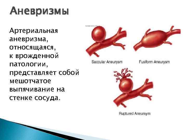 Аневризмы Артериальная аневризма, относящаяся, к врожденной патологии, представляет собой мешотчатое выпячивание на стенке сосуда.