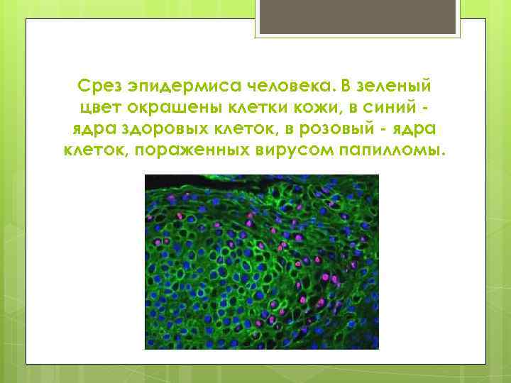 Срез эпидермиса человека. В зеленый цвет окрашены клетки кожи, в синий ядра здоровых клеток,