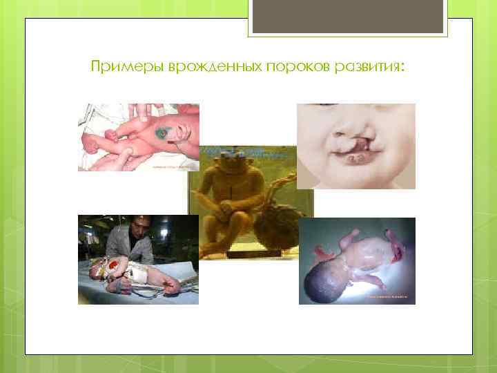 Примеры врожденных пороков развития: 