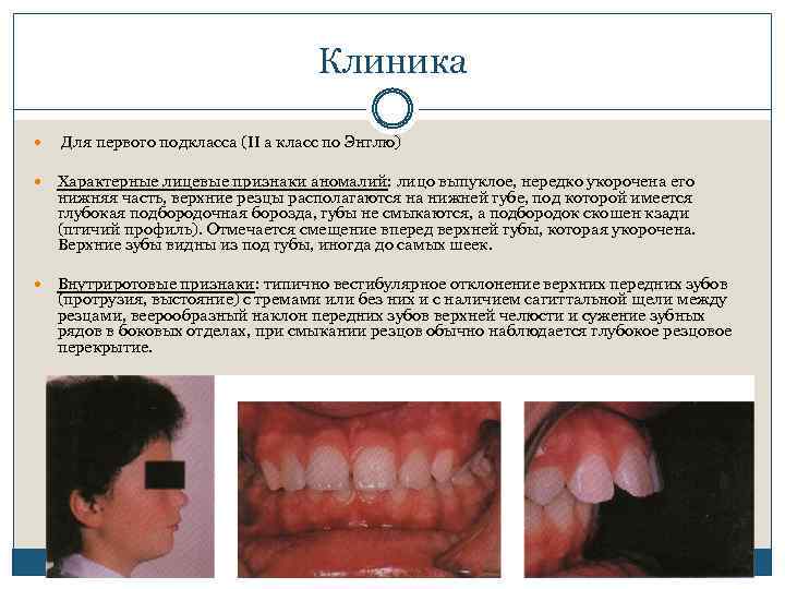 Клиника Для первого подкласса (II a класс по Энглю) Характерные лицевые признаки аномалий: лицо